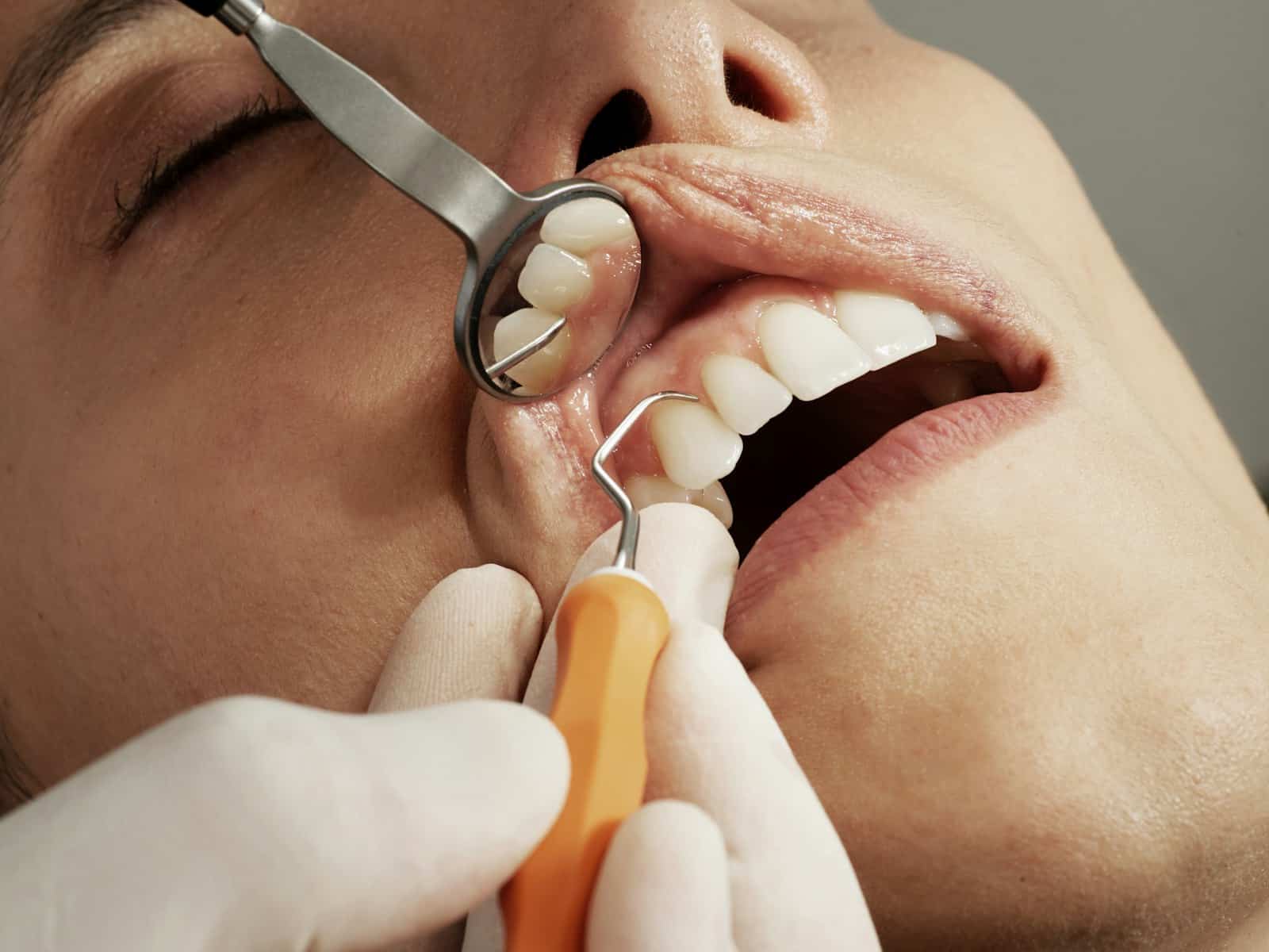 Urgencias odontológicas en Medellín: instrumental de exploración dental, imagen de referencia