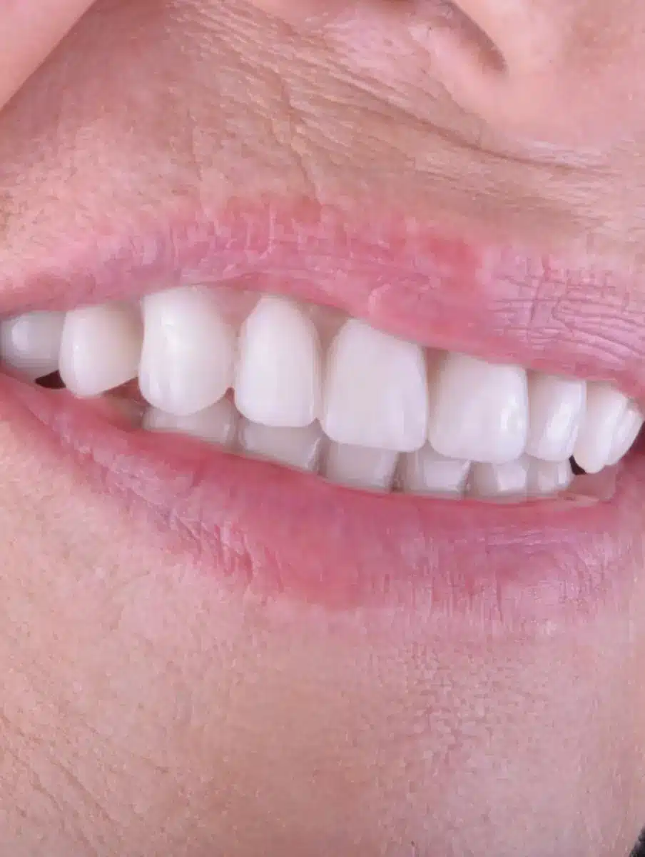 Resultado de una prótesis dental