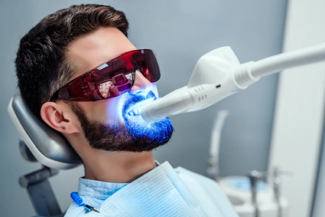 Blanqueamiento dental con lámpara en el consultorio