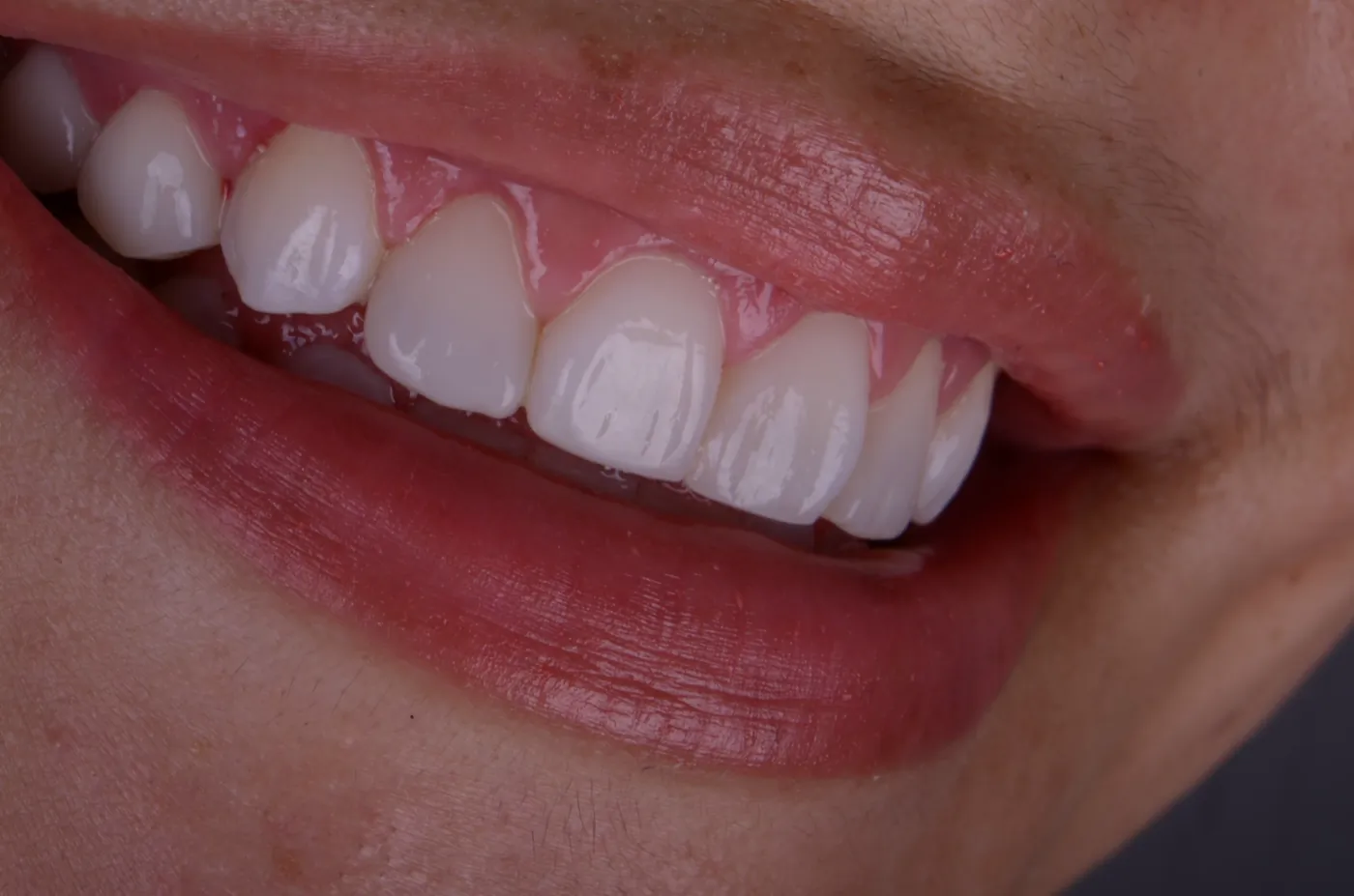 Upper front teeth covered with porcelain veneers, seen close up