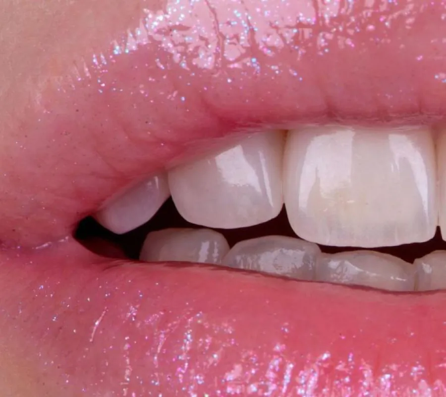 Detalle de unas carillas de porcelana sobre los dientes superiores