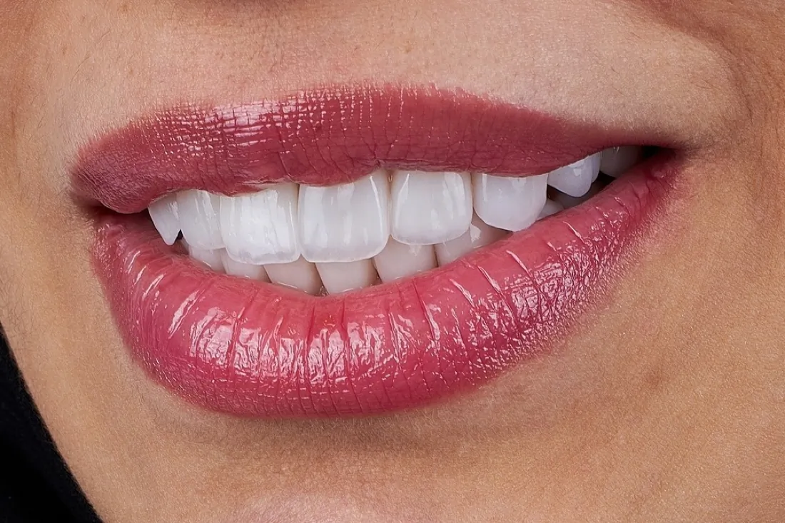 Close-up of a smile with even front teeth after a smile makeover