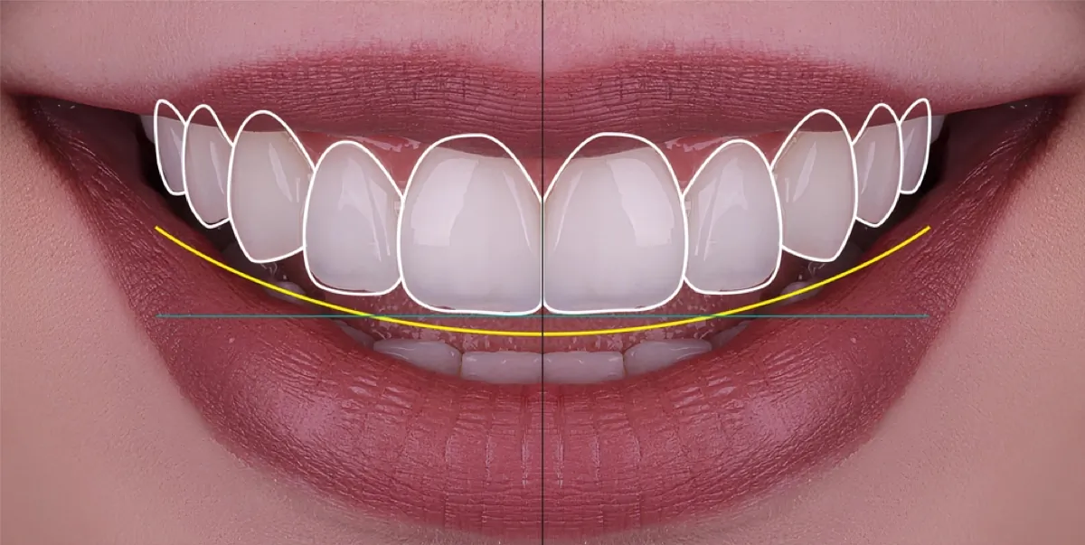 Digital smile design guide lines drawn over the front teeth