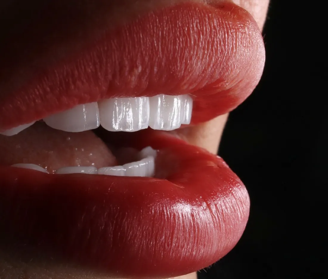 Close-up of a smile with porcelain veneers